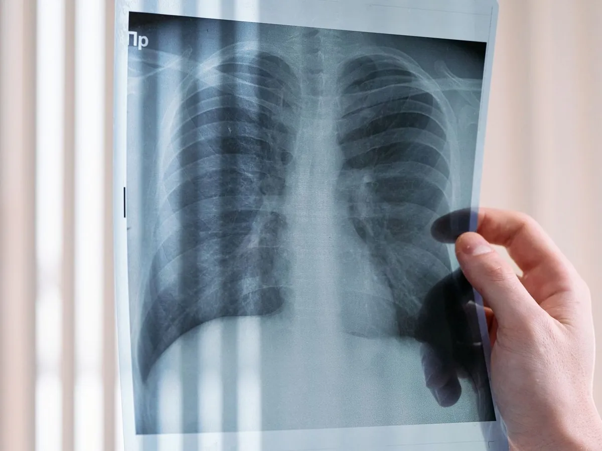 HRCT review and ILD diagnostic evaluation